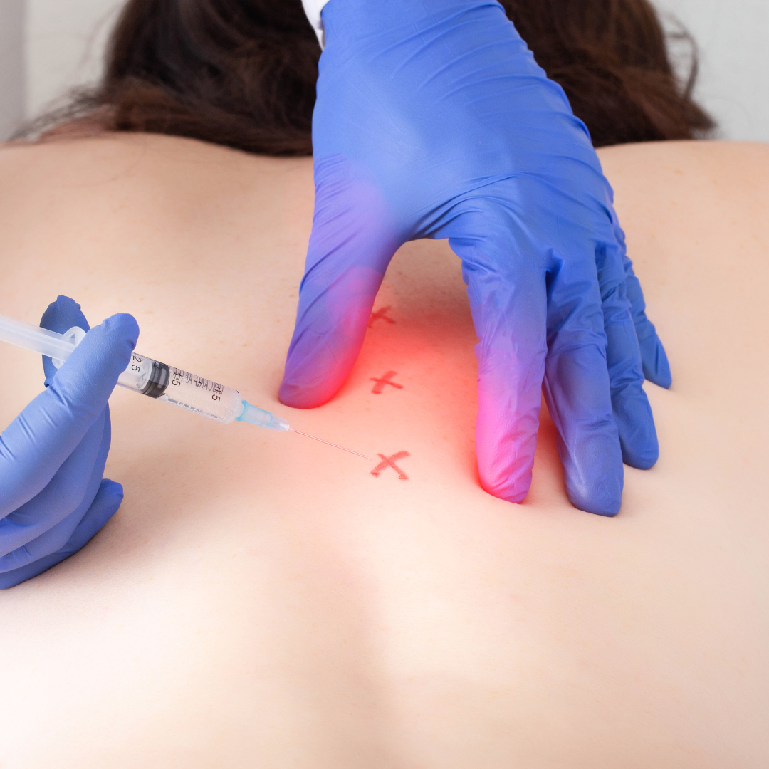 Epidural Steroid Injections: How They Can Help You - OverbookMD